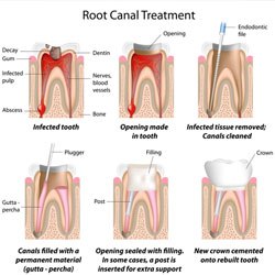 root canal Treatment